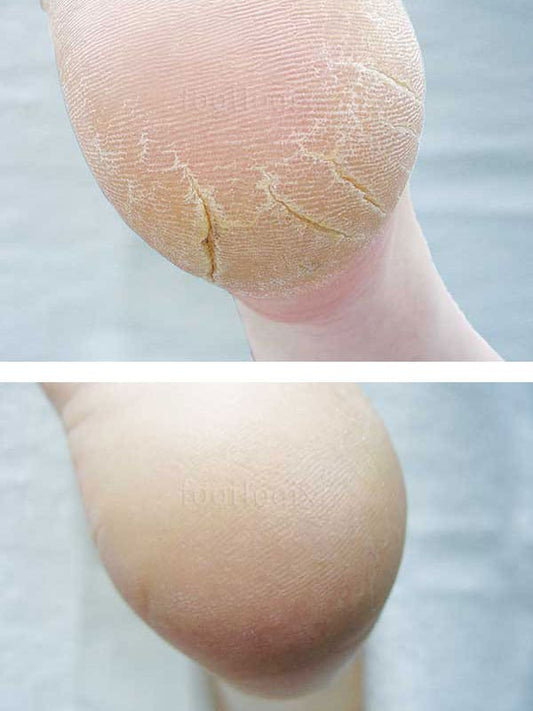 Footlogix putos suskeldėjusioms pėdoms – cracked heel formula Nr. 3+